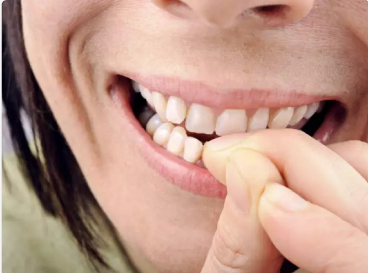 Theo nghiên cứu, những người cắn móng tay có nhiều khả năng mắc chứng nghiến răng - hành động nghiến răng không chủ ý. Thói quen này có thể dẫn đến đau đầu, đau mặt, tụt nướu, ê buốt răng và thậm chí mất răng.