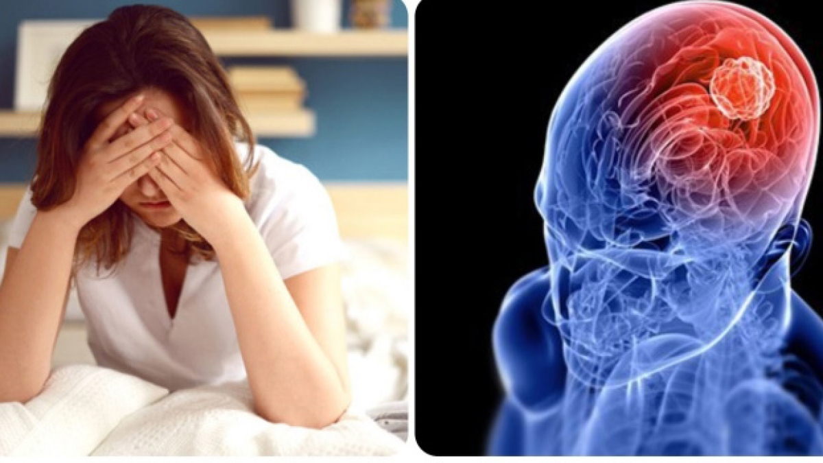 Các bác sĩ cho biết các khối u não gây ra những cơn đau đầu rất đặc trưng thường nặng hơn vào buổi sáng.