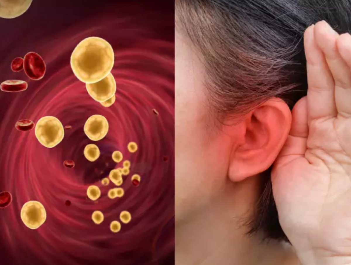 Cholesterol là chất béo mà cơ thể cần để hoạt động bình thường. Tuy nhiên, quá nhiều cholesterol xấu sẽ làm tăng nguy cơ mắc các vấn đề nghiêm trọng đến sức khỏe, chẳng hạn như bệnh tim và đột quỵ.