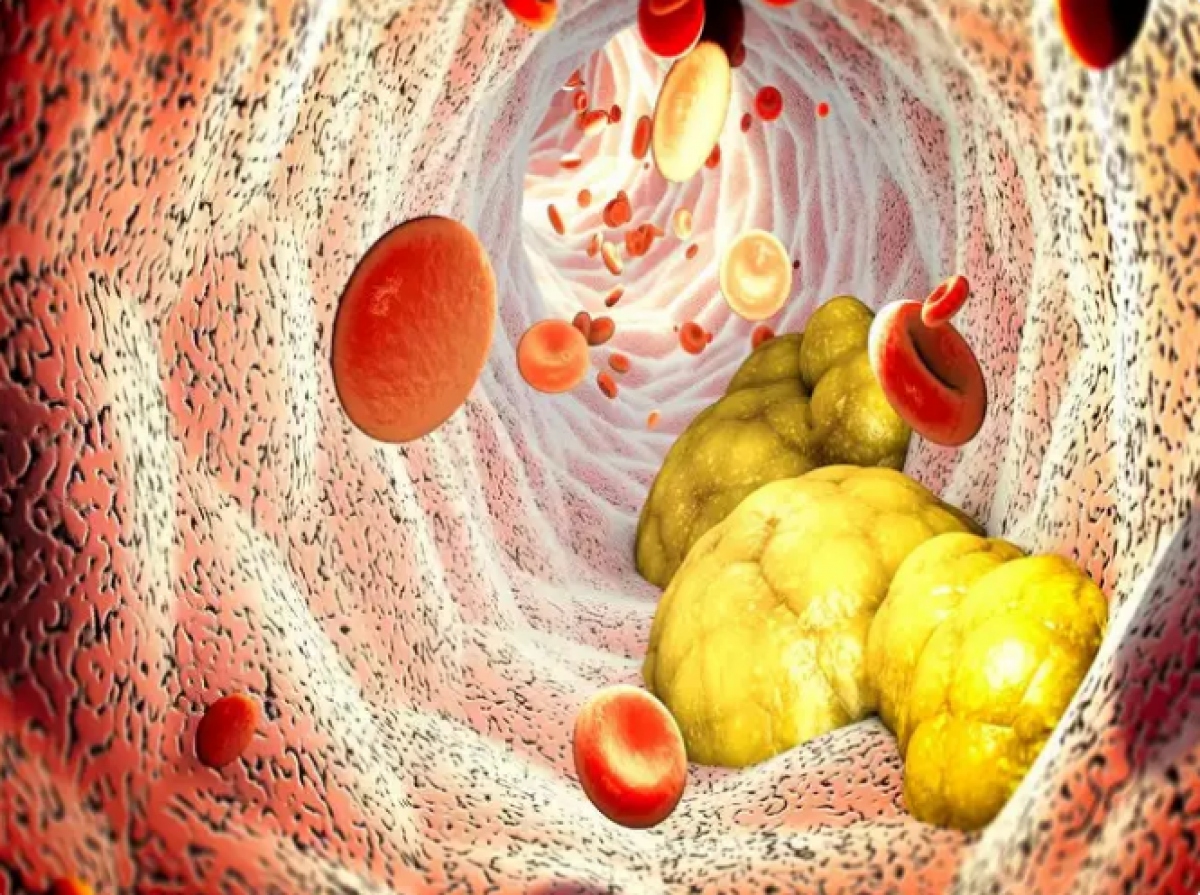 Mất thính lực: Một dấu hiệu cảnh báo ít được biết đến về lượng cholesterol cao là mất thính giác. Mặc dù đây có thể không phải là dấu hiệu cảnh báo đầu tiên nhưng điều quan trọng là bạn không nên bỏ qua nếu bạn gặp khó khăn khi nghe. Theo các chuyên gia y tế, tình trạng suy giảm thính lực do cholesterol cao có xu hướng diễn ra từ từ và thường ảnh hưởng đến cả hai tai.