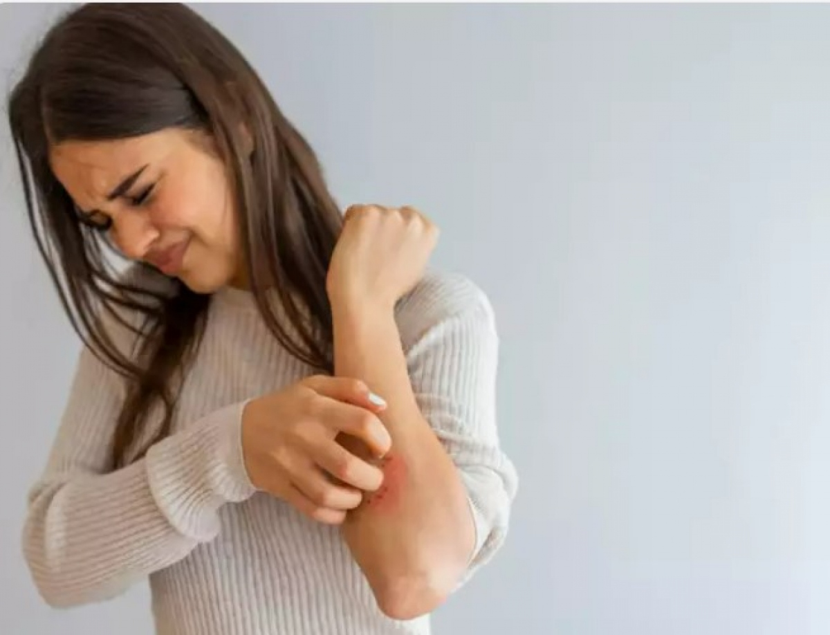 Bệnh vẩy nến là một tình trạng bệnh phức tạp, chịu ảnh hưởng bởi sự kết hợp của các yếu tố di truyền, miễn dịch và môi trường. Các nghiên cứu gần đây đã tiết lộ mối liên hệ giữa sức khỏe đường ruột và sự khởi phát hoặc làm trầm trọng thêm bệnh vẩy nến. Hệ vi sinh vật đường ruột, một cộng đồng đa dạng gồm các vi sinh vật cư trú trong đường tiêu hóa, đóng vai trò then chốt trong việc duy trì sức khỏe tổng thể. Khi sự cân bằng của hệ vi sinh vật này bị phá vỡ sẽ gây ra những ảnh hưởng sâu rộng đến các hệ thống cơ thể khác nhau, bao gồm cả hệ thống miễn dịch.
