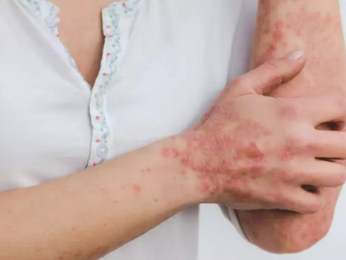 Sức khỏe đường ruột liên quan đến bệnh vẩy nến: Tỷ lệ tương đối của vi khuẩn đường ruột cụ thể có liên quan đến mức độ nghiêm trọng của bệnh vẩy nến. Ví dụ, sự phát triển quá mức của một số vi khuẩn tạo ra các hợp chất gây viêm làm trầm trọng thêm các triệu chứng về da. Ngược lại, một hệ vi sinh vật đường ruột khỏe mạnh sẽ hỗ trợ cân bằng miễn dịch và giúp điều chỉnh tình trạng viêm, làm giảm các đợt bùng phát bệnh vẩy nến. Trong khi các cơ chế chính xác vẫn đang được nghiên cứu, những phát hiện này nhấn mạnh tầm quan trọng của việc duy trì sức khỏe đường ruột như một biện pháp phòng ngừa bệnh vẩy nến.