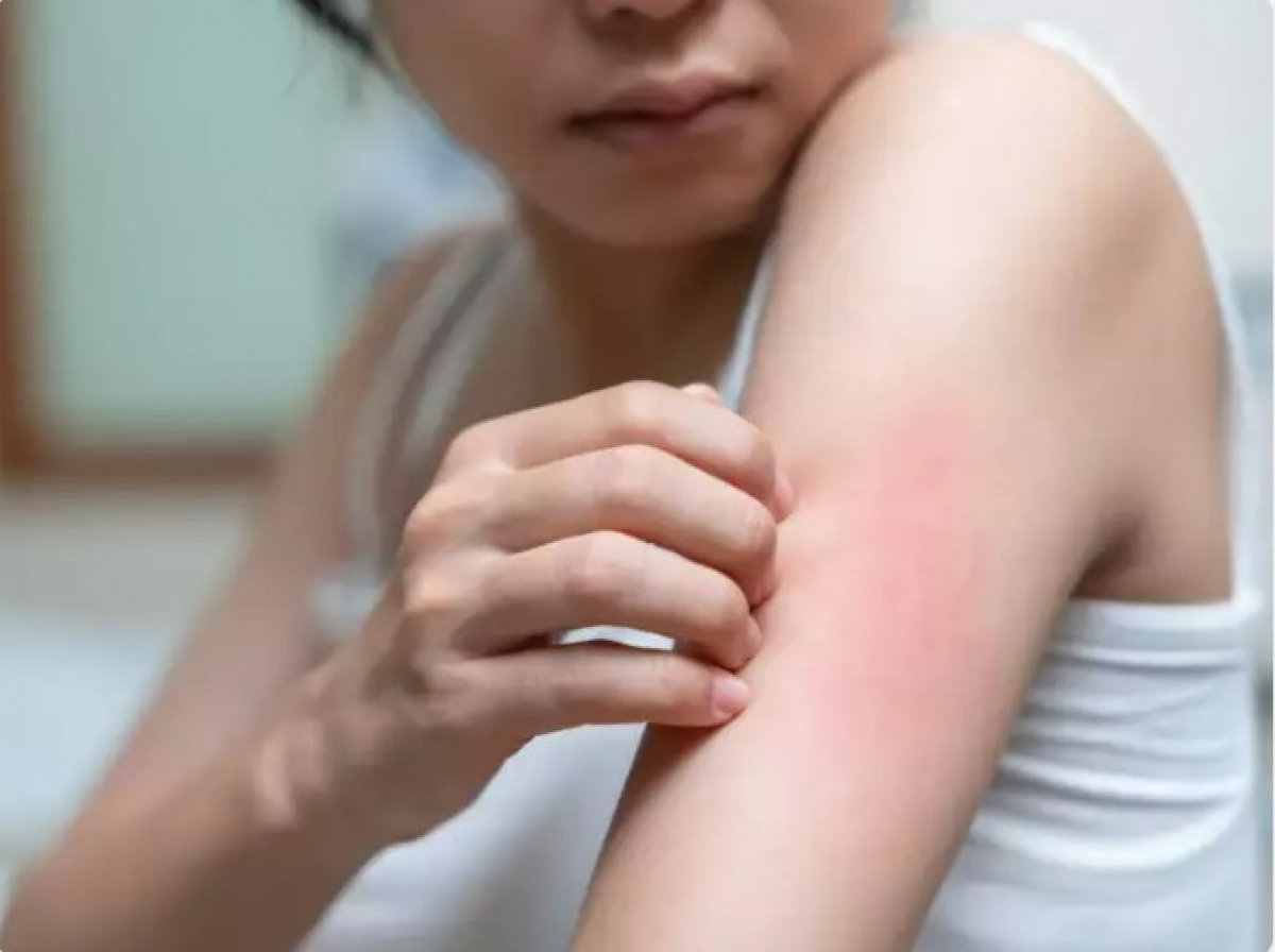 Các biện pháp phòng ngừa cho sức khỏe làn da: Mặc dù di truyền đóng một vai trò quan trọng trong nguy cơ mắc bệnh vẩy nến, nhưng có một số hành động phòng ngừa mà các cá nhân có thể thực hiện để tăng cường sức khỏe của da và có khả năng làm giảm nguy cơ phát triển bệnh vẩy nến: Chế độ ăn uống cân bằng; Probiotic và prebiotic; hydrat hóa; Kiểm soát căng thẳng; Tham khảo ý kiến bác sĩ da liễu