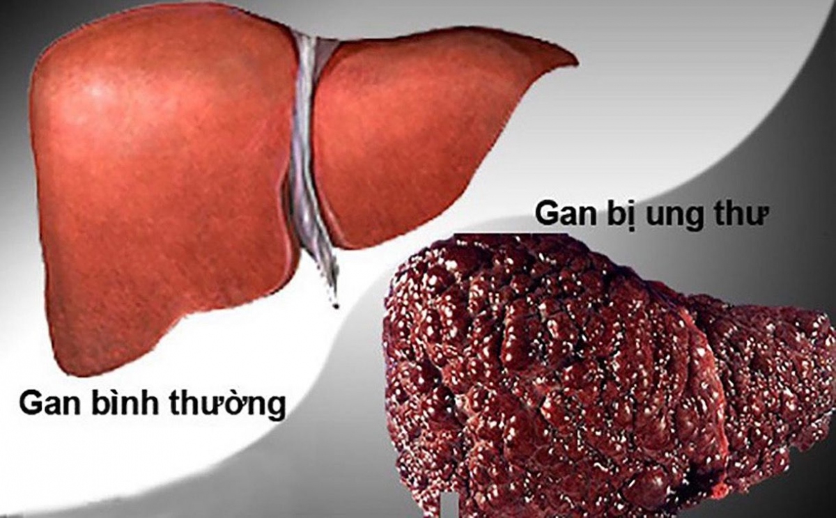 Ung thư gan đã vượt qua ung thư phổi là bệnh đứng đầu ở Việt Nam với số ca mắc mỗi năm gần 26.500 ca, chiếm 14,5% tổng số ca ung thư, trong đó, 77% số ca ung thư gan là nam giới...