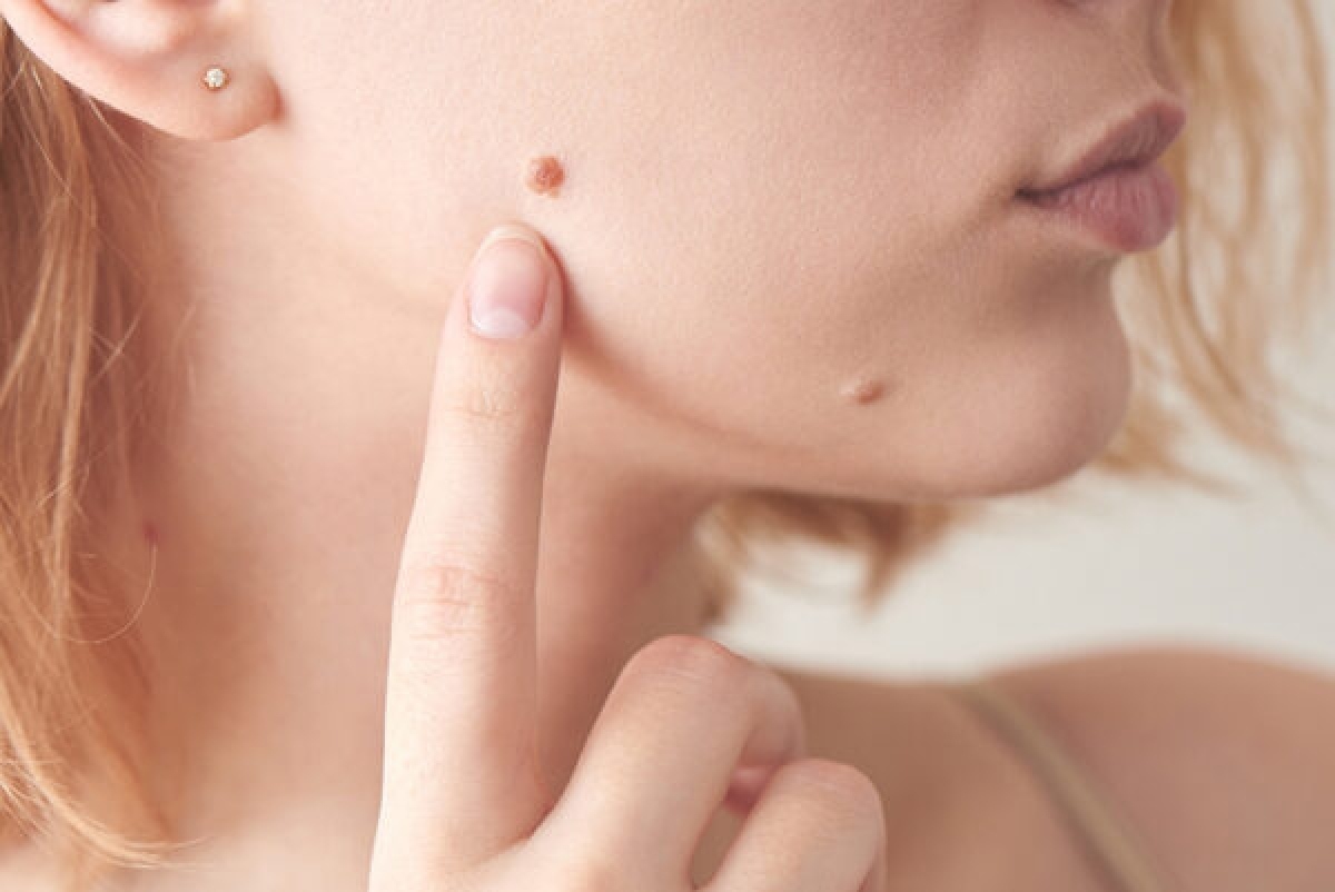 Nhiều người lầm tưởng nốt ruồi không đau, không ngứa, không gây khó chịu là bình thường