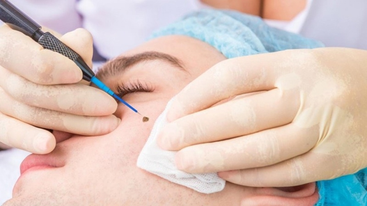 Nốt ruồi có màu sắc bất thường, đường kính hơn 6mm được đánh giá có yếu tố nguy cơ ung thư cao