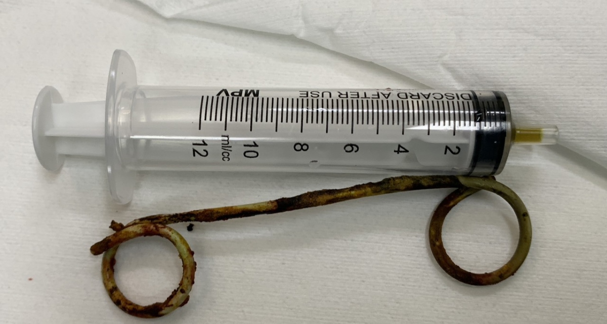 Stent được lấy ra từ ống mật chủ của bệnh nhân sau 6 năm.
 