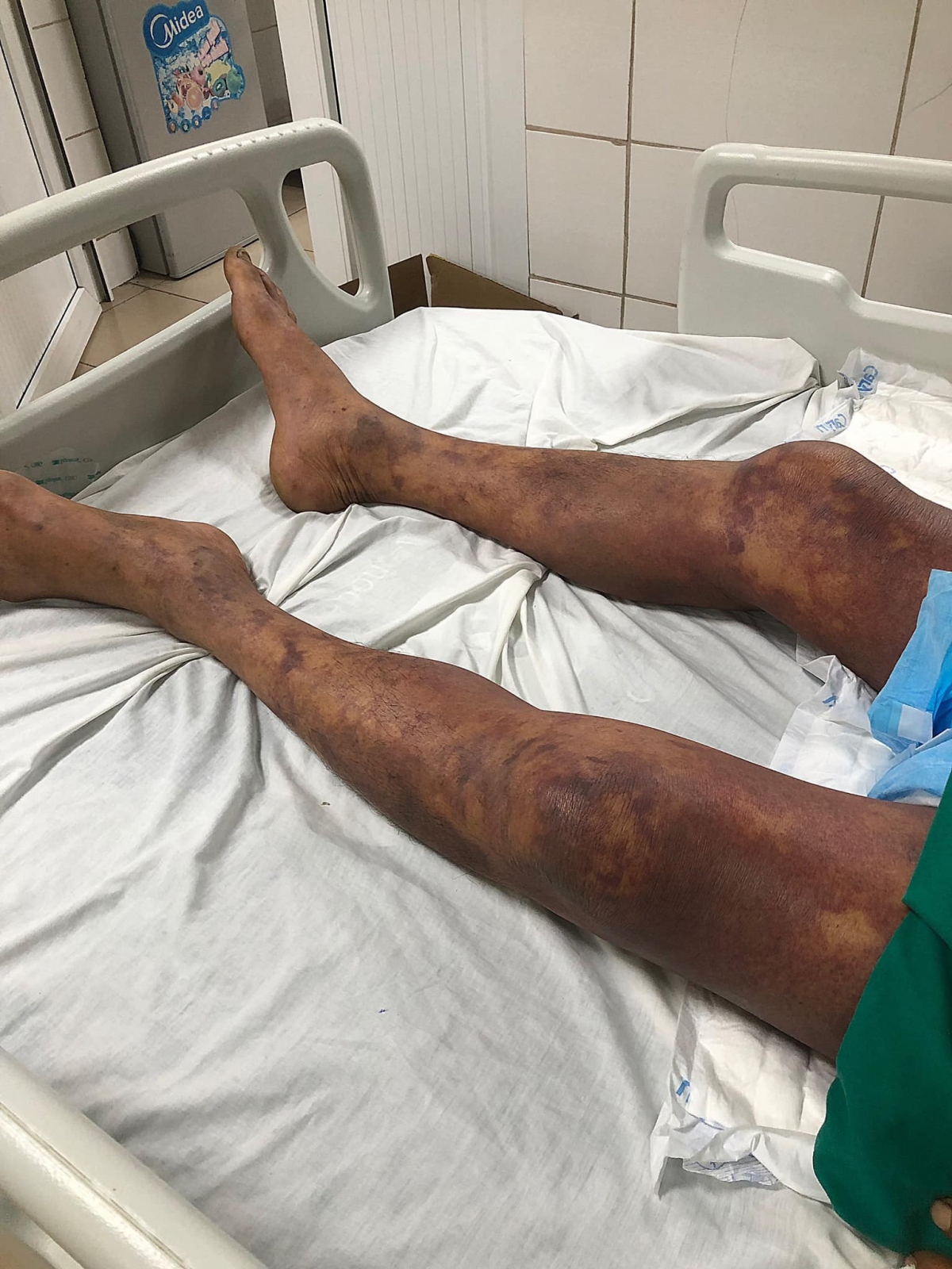 Nam bệnh nhân nhập viện trong tình trạng bị sốt cao sốt cao, rét run, mệt mỏi, đi ngoài phân lỏng nhiều lần trong ngày