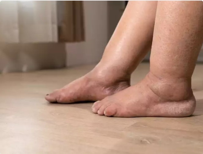 Kết luận: Sau khi tiến hành các xét nghiệm chẩn đoán cần thiết, bác sĩ sẽ trao đổi kết quả với bệnh nhân. Trong trường hợp chẩn đoán ung thư, những kết quả này hỗ trợ việc mô tả bệnh ung thư và xác định giai đoạn cũng như mức độ của nó. Phân giai đoạn và phân loại giúp hướng dẫn phương pháp điều trị thích hợp. Điều quan trọng đối với những người mắc bệnh sarcoma xương là tìm kiếm sự chăm sóc tại trung tâm chuyên khoa về bệnh sarcoma, nơi các chuyên gia có thể đảm bảo chẩn đoán chính xác và đưa ra phương pháp điều trị thích hợp.