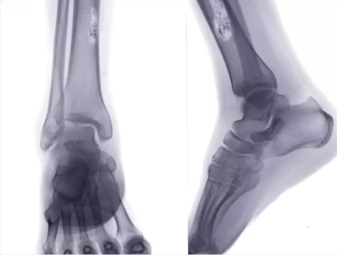 Chụp cắt lớp phát xạ positron (PET) hoặc chụp PET-CT: Chụp PET thường được kết hợp với chụp CT để xác định giai đoạn của sarcoma xương. Một chất đường phóng xạ được tiêm vào cơ thể, chất này sẽ được các tế bào tích cực sử dụng năng lượng hấp thụ, trong đó có tế bào ung thư. Máy quét phát hiện chất này, tạo ra hình ảnh của các cơ quan và mô.