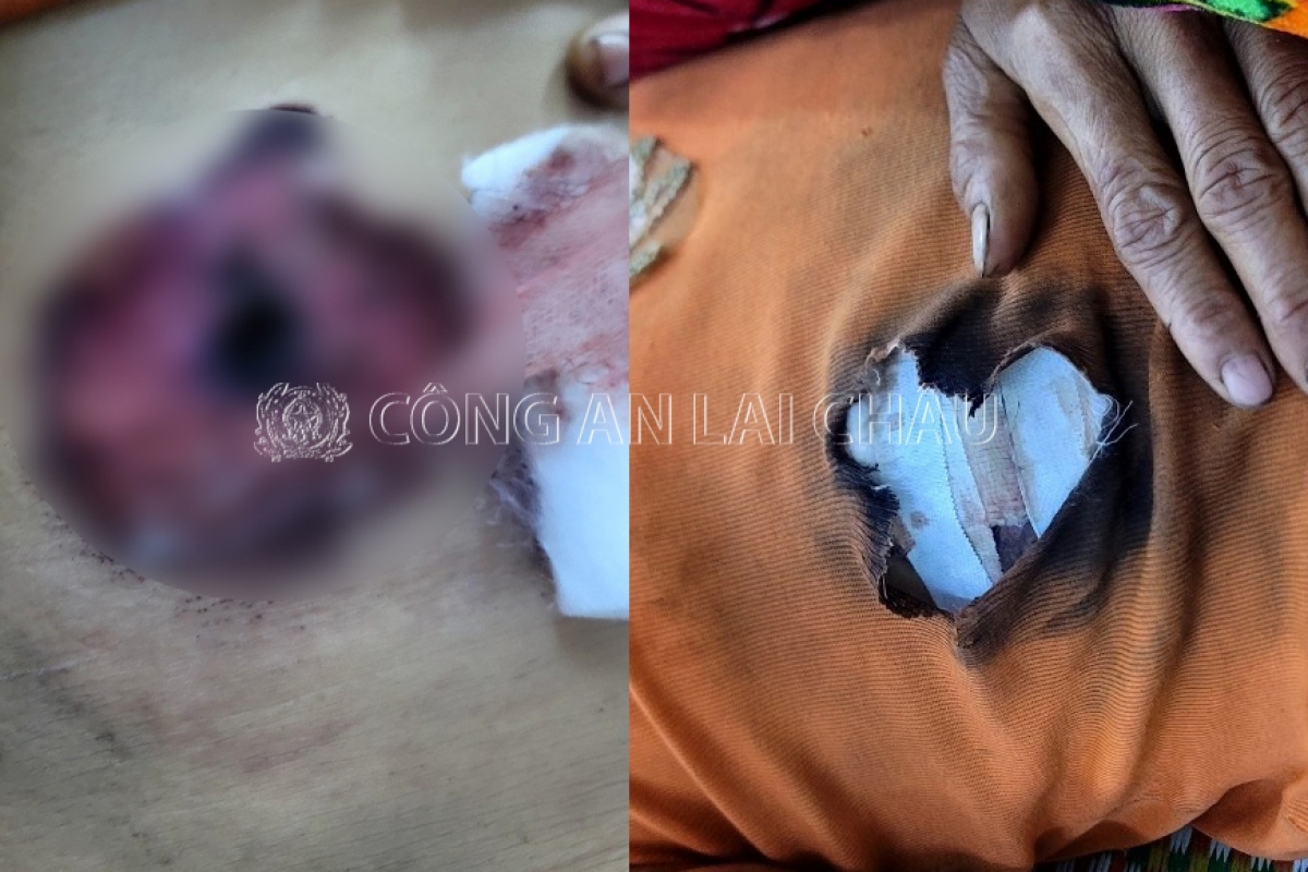 Bị vết thương nặng ở bụng, chị M hiện đang được cấp cứu tại Bệnh viện Đa khoa tỉnh Lai Châu.