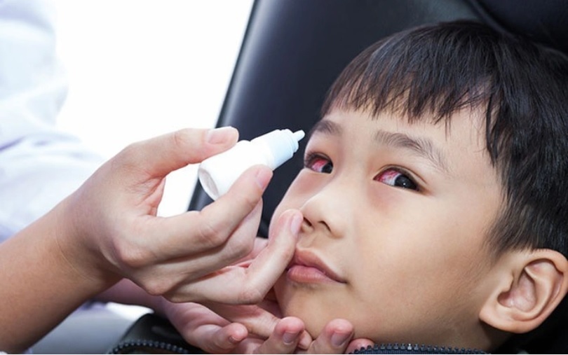 Bệnh đau mắt đỏ đã xuất hiện tại Quảng Bình và lây lan nhanh, nhất là ở trẻ mầm non và tiểu học. Ảnh minh họa.