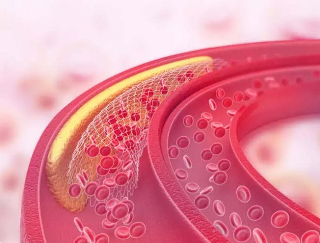 Nguyên nhân gây ra cholesterol cao? Yếu tố di truyền và lối sống góp phần làm tăng mức cholesterol. Mặc dù bạn không thể thay đổi nguyên nhân di truyền nhưng việc lựa chọn lối sống đóng một vai trò quan trọng. Một chế độ ăn uống không lành mạnh, thiếu hoạt động thể chất, hút thuốc và uống quá nhiều rượu đều dẫn đến mức LDL-C cao hơn.