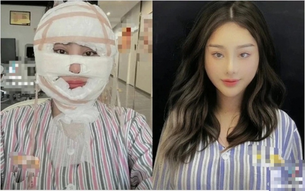 Vừa qua, hình ảnh được cho là Lâm Khánh Chi tiếp tục can thiệp "dao kéo" thu hút sự quan tâm của khán giả. Ngoài ra, ca sĩ chuyển giới còn đăng tải đoạn video băng bó kín mặt, kèm chia sẻ: "Hành trình của thanh xuân". Bên dưới video, nhiều người để lại bình luận khuyên người đẹp chuyển giới nên ngừng trùng tu nhan sắc để giữ gìn sức khỏe.