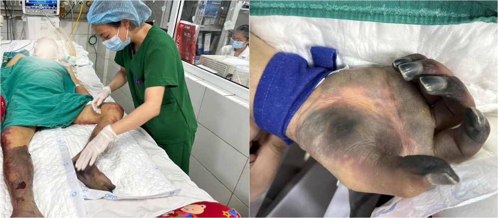 Hình ảnh bệnh nhân bị hoại tử 2 bàn chân và phần ngón tay ở 2 bàn tay do mắc liên cầu lợn (Ảnh do Bệnh viện cung cấp)