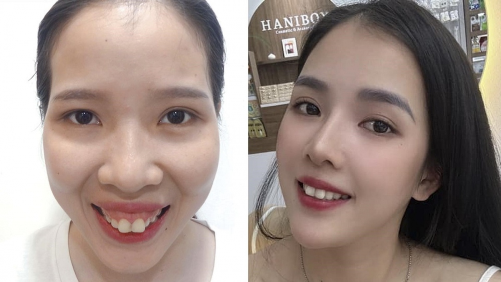 Phẫu thuật thẩm mỹ là chính mình, lựa chọn đẹp an toàn bền vững