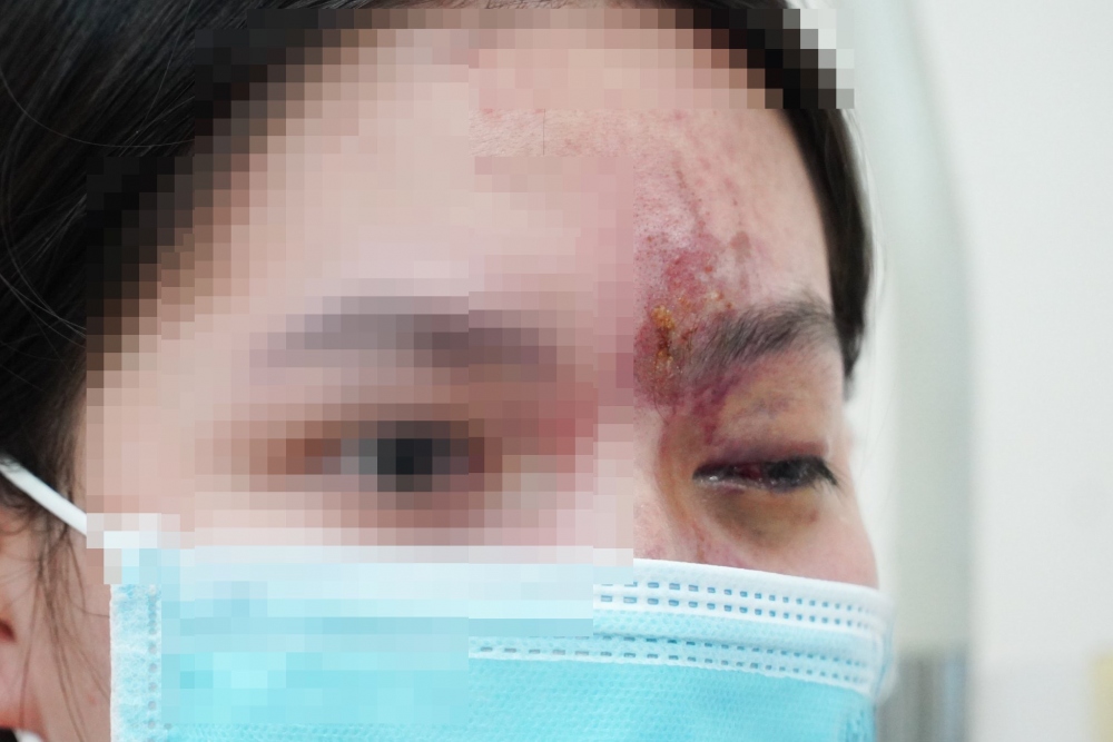 Bệnh nhân bị mù mắt trái sao khi tiêm filler ở spa chui (Ảnh Bệnh viện Chợ Rẫy)