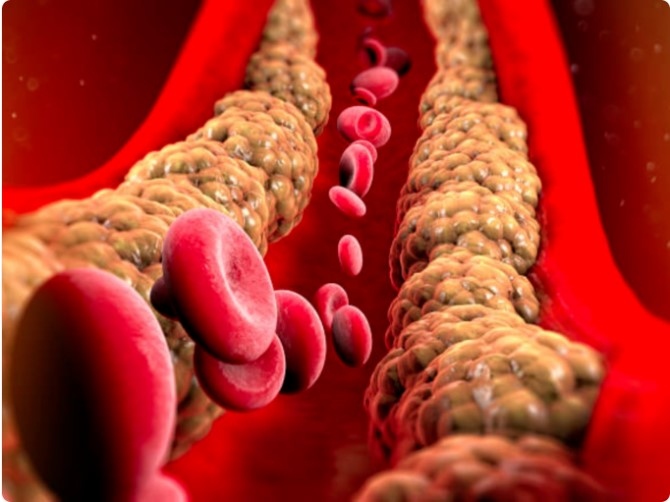 Huyết áp cao: Tăng huyết áp thường tồn tại cùng với mức cholesterol cao, góp phần gây căng thẳng cho hệ tim mạch. Theo dõi huyết áp thường xuyên là điều cần thiết.