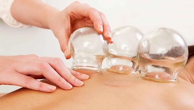Giác hơi là cách chữa bệnh trong Đông y