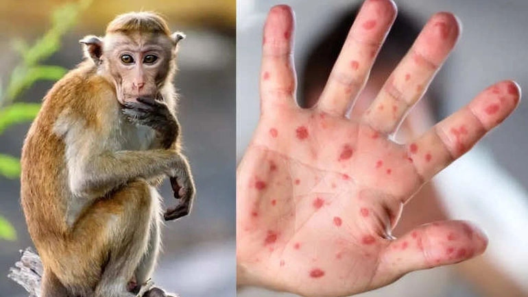 Sở Y tế Cà Mau báo cáo về trường hợp bệnh nhân nghi mắc bệnh đậu mùa khỉ.