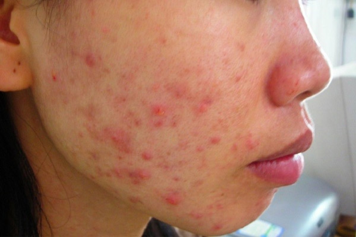 Tình trạng mụn bọc, mụn viêm nổi rầm rộ trong thai kỳ