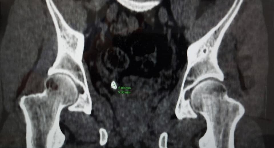 Hình ảnh phim chụp CT khu phát hiện bất thường của bệnh nhân có 4 quả thận trong cơ thể (Ảnh Bệnh viện cung cấp)
