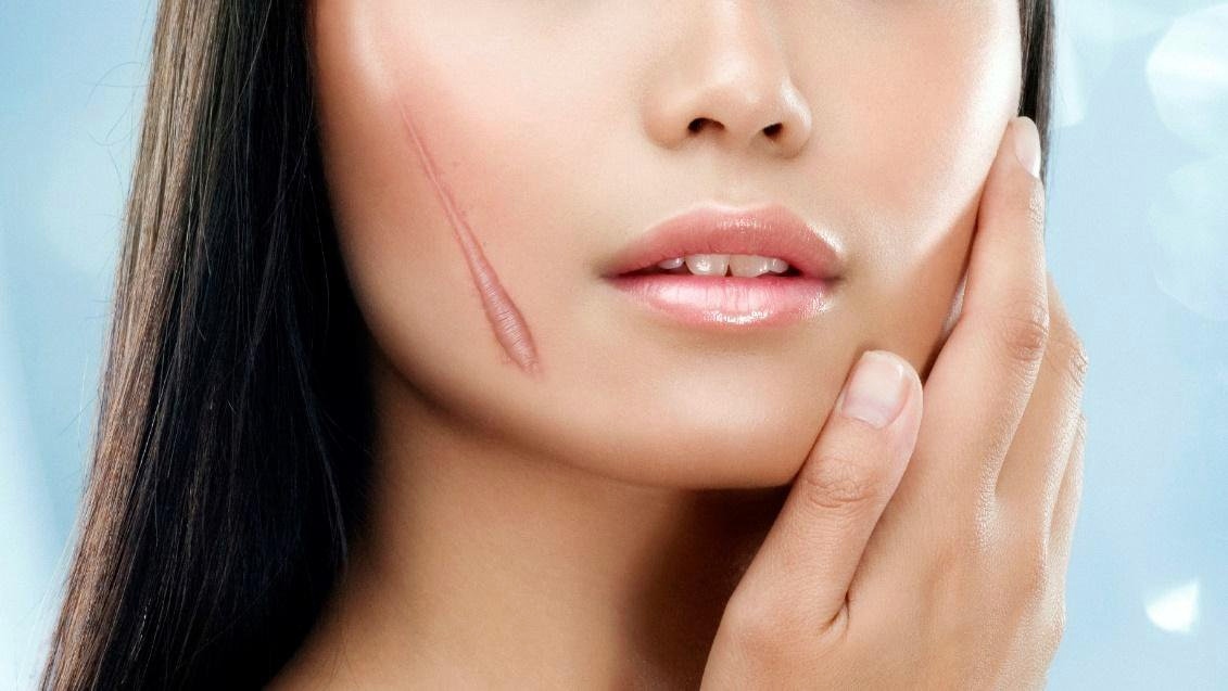 Sẹo khiến người bị luôn tự ti, mặc cảm