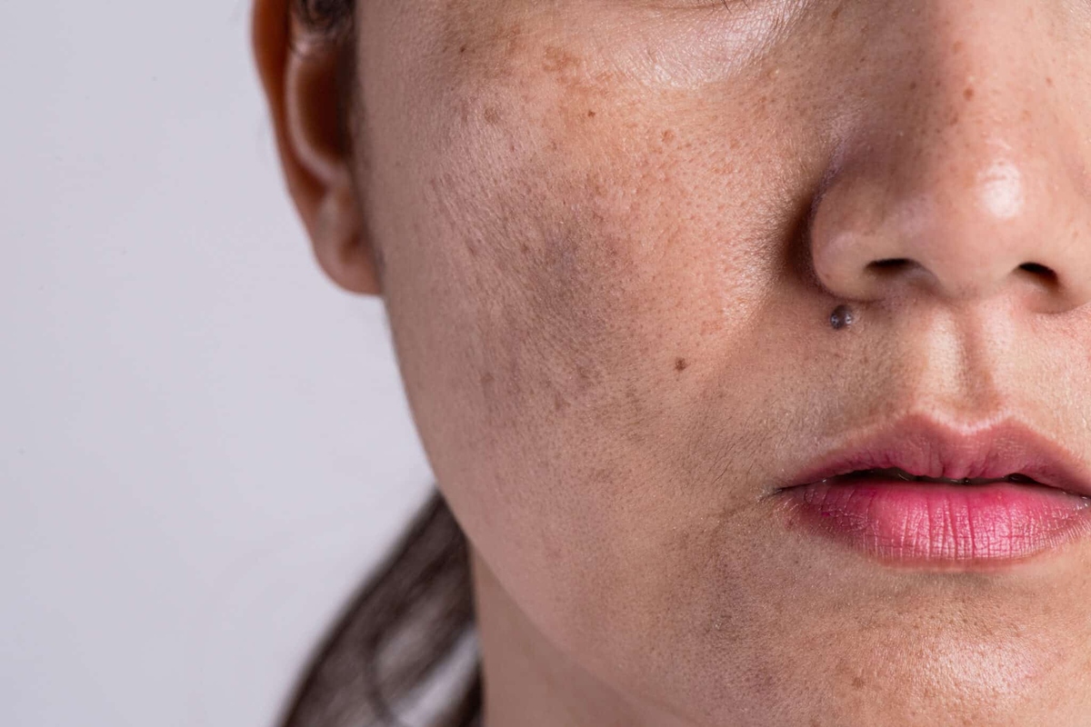 Phụ nữ bị sạm, nám da do rối loạn nội tiết tố (Nguồn ảnh: 1Aesthetics)