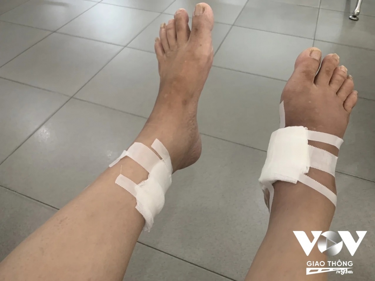 Vết thương bị chó cắn sâu khiến bệnh nhân phải dùng xe lăn hỗ trợ mỗi lần đi tiêm phòng