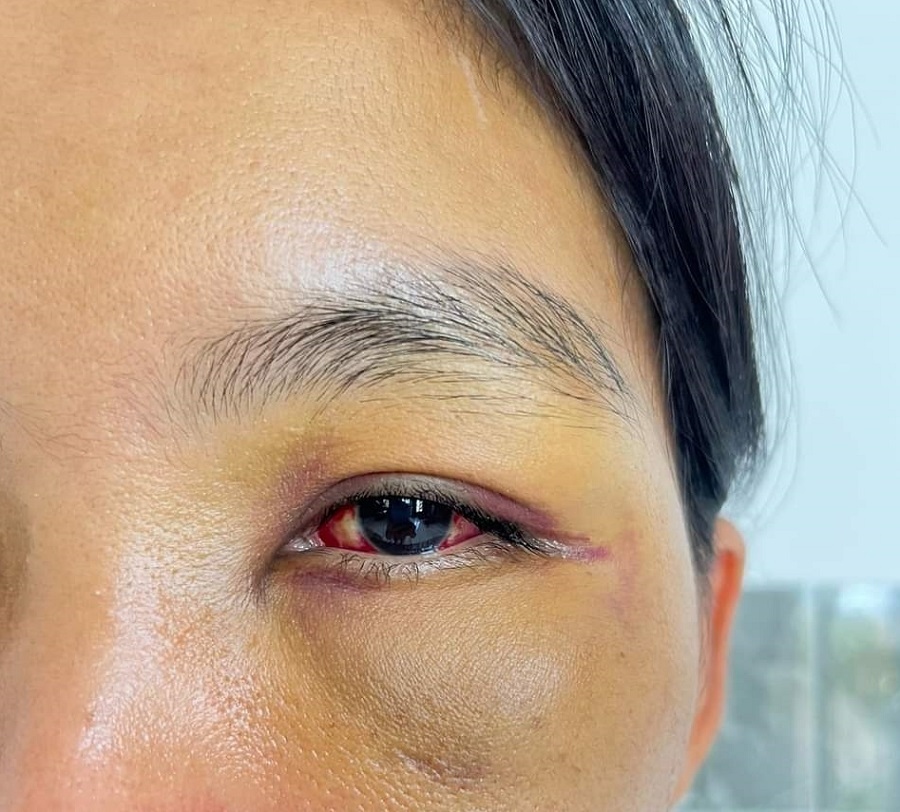 Con mắt chị D sưng, bầm. (Ảnh: Mạng xã hội)