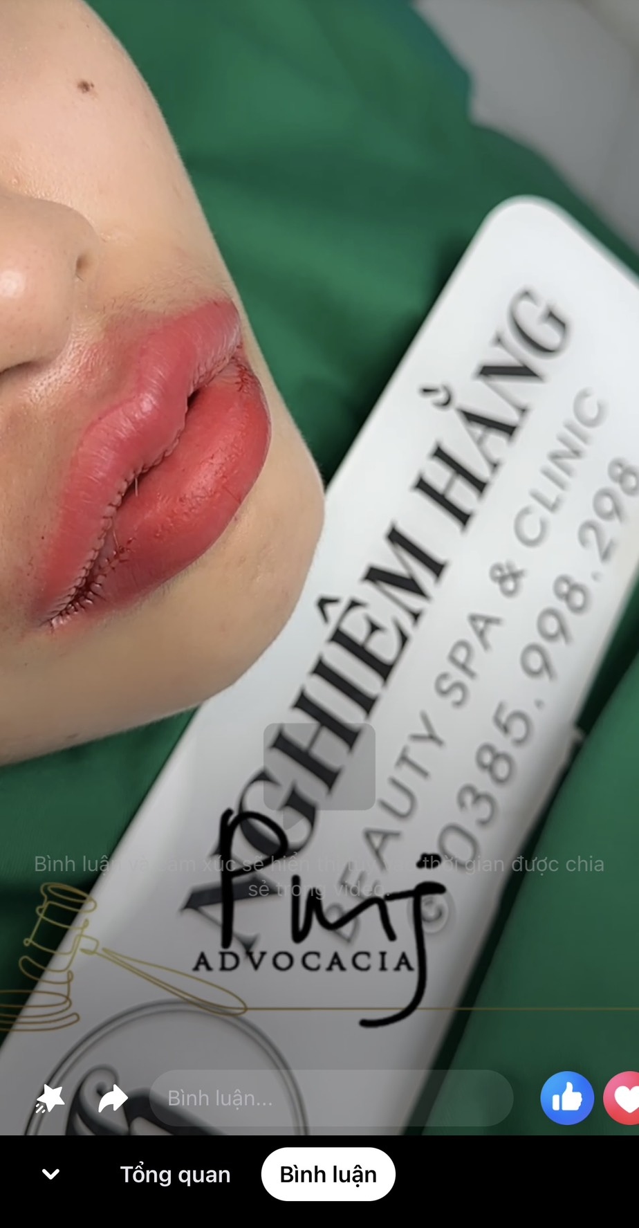 Đến cuối ngày 24/4, trên Facebook của cơ sở làm đẹp kia vẫn còn đăng clip ca cắt môi của chính cô gái này để quảng cáo mà không hề hay biết về tình trạng của bệnh nhân 