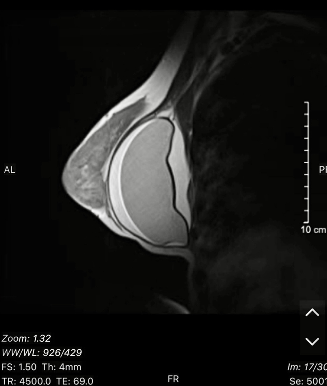 Hình ảnh MRI ngực trái của bệnh nhân (Ảnh: BSCC)