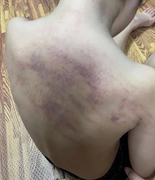 Cháu N.H.N. bị bầm tím một mảng lớn ở lưng (Ảnh: gia đình cung cấp)
