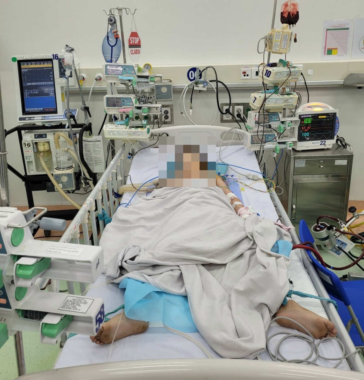 Bé gái 6 tuổi viêm cơ tim tối cấp bị ngưng tim 60 phút đã được cứu sống ngoạn mục (Ảnh bác sĩ cung cấp)