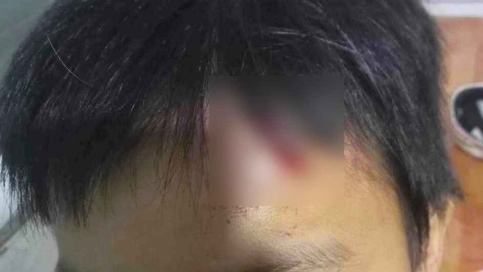 Vết thương trên trán cháu M.T.