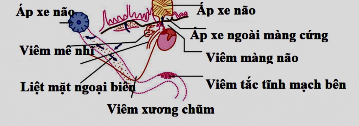 Biến chứng nội sọ và ngoại sọ do tai