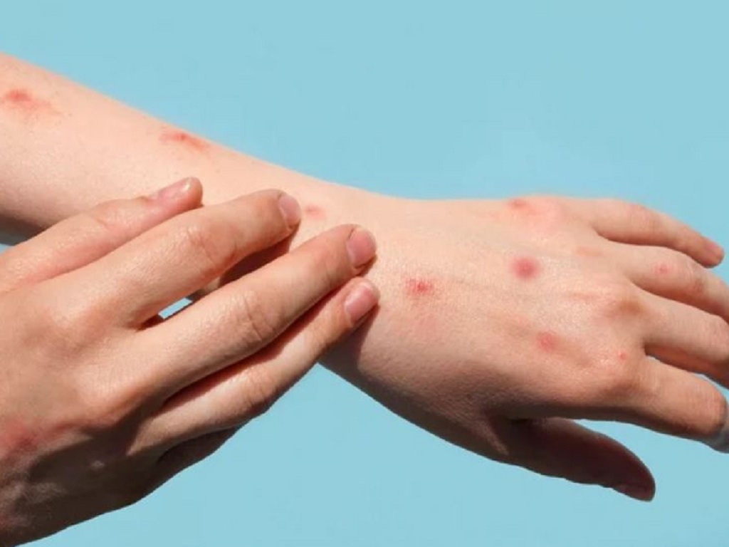 Triệu chứng bệnh đậu mùa khỉ. Ảnh: Getty