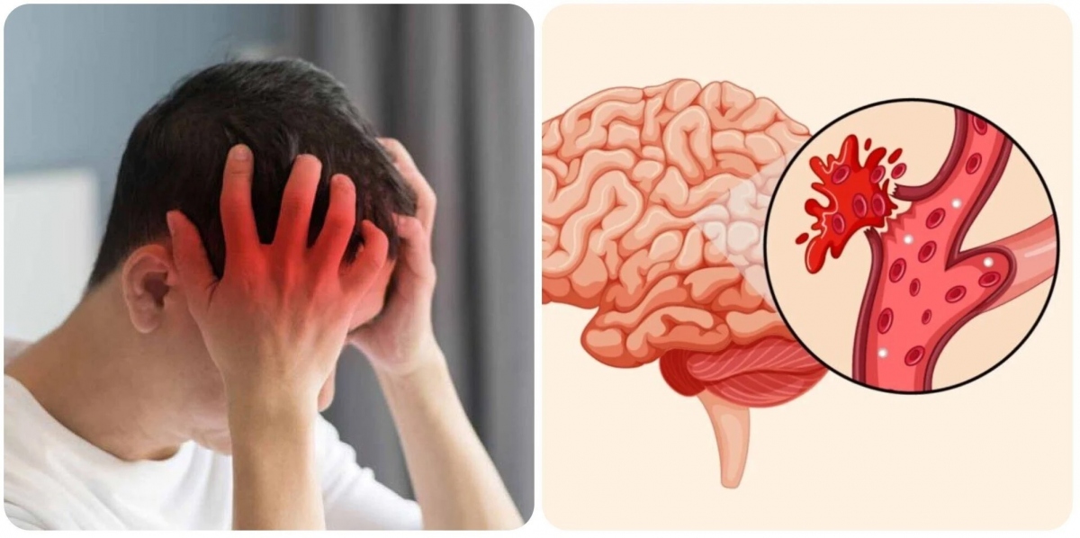 Có nhiều thói quen dễ gây ra đột quỵ trong mùa hè.