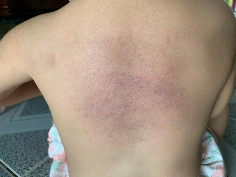 Sau lưng cháu bé bầm tím. Ảnh MXH