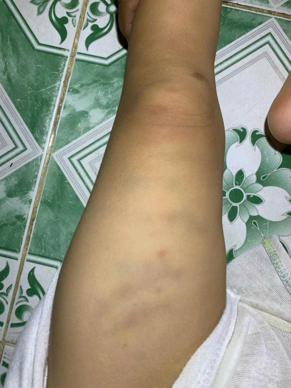 Chân cháu bé bị bầm. Ảnh: MXH