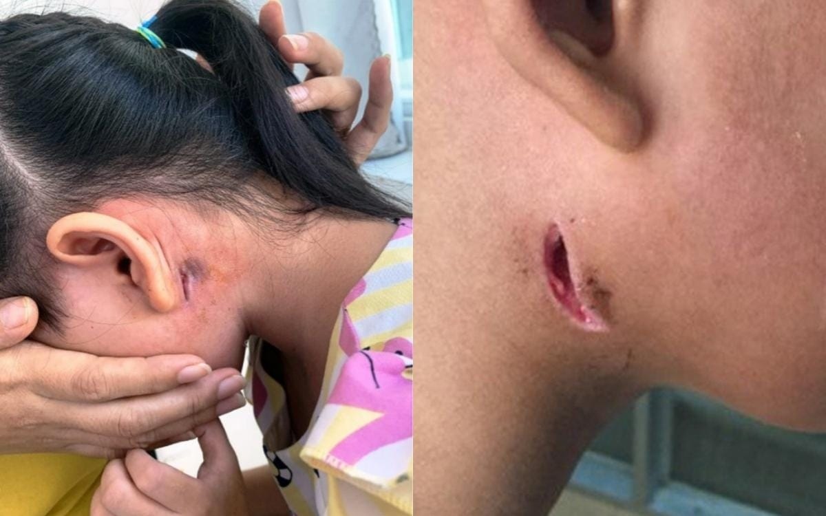 Bệnh nhân mắc Whitmore (Ảnh minh họa của CDC Đồng Nai)