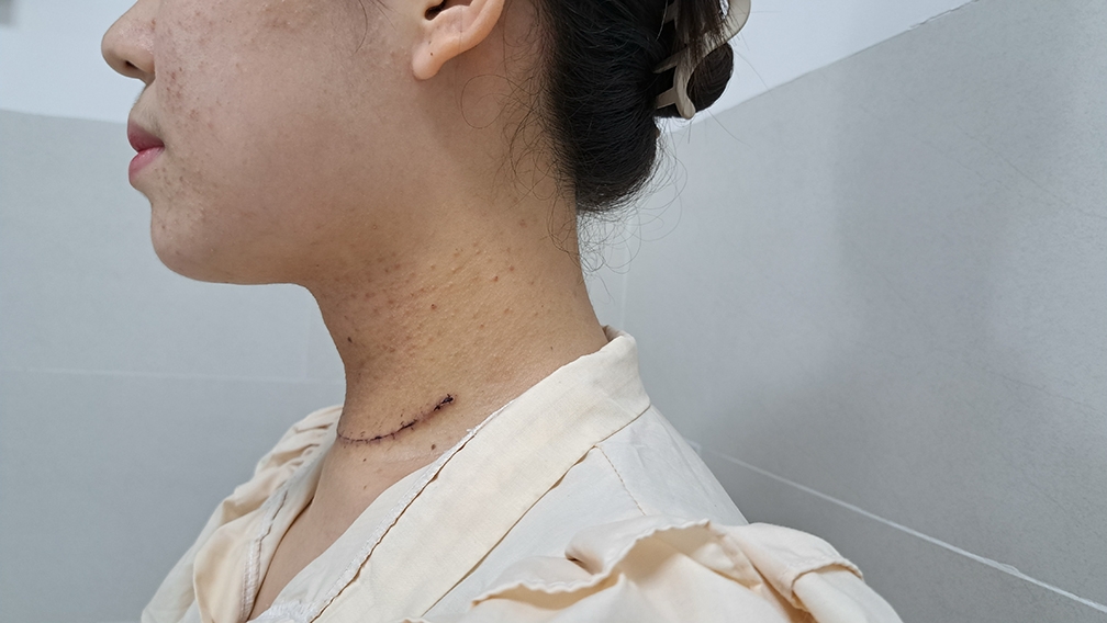 Do khối u quá lớn nên vết mổ dài, hiện bệnh nhân đã ổn định và xuất viện