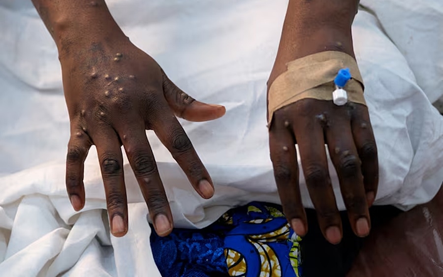 Bàn tay của một bệnh nhân mắc virus gây bệnh đậu mùa khỉ (Mpox). Ảnh: Reuters.