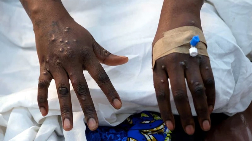 Một bệnh nhân bị phát ban trên da do vi rút đậu mùa khỉ - Ảnh: Reuters