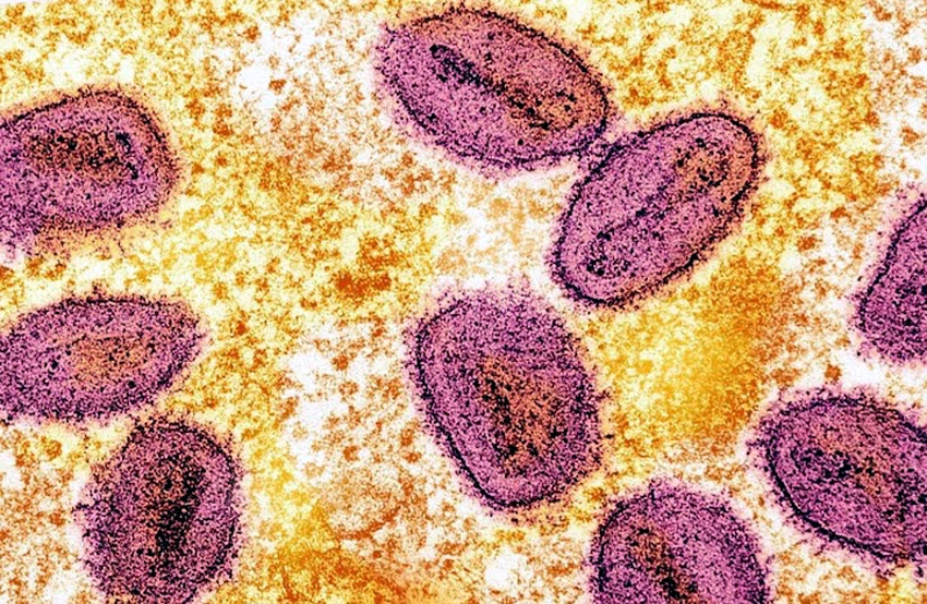 Virus đậu mùa khỉ (màu hồng) dưới kính hiển vi - Ảnh: Reuters.