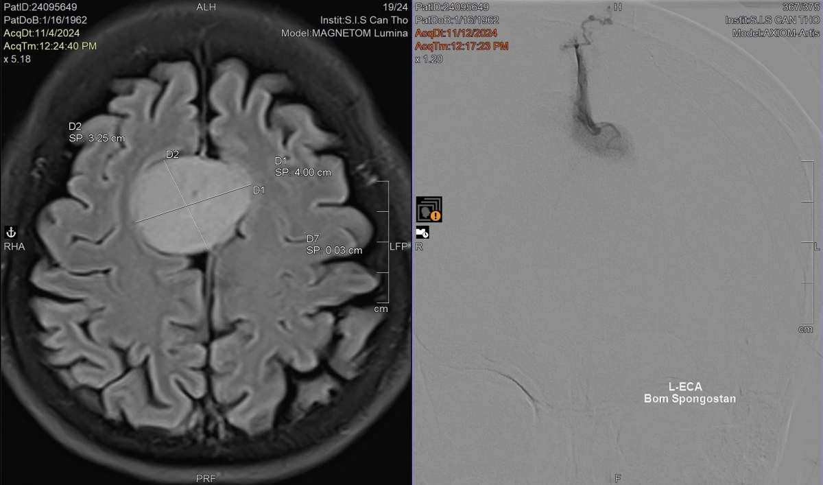 Hình ảnh MRI của bệnh nhân trước phẫu thuật