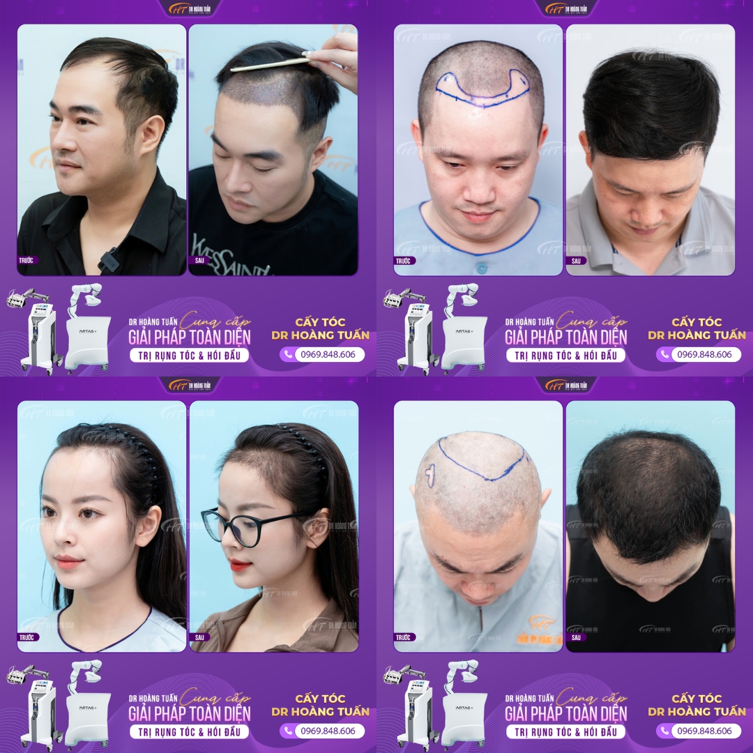 Hình ảnh khách hàng trước và sau khi cấy tóc tại trung tâm cấy tóc phòng khám Đa khoa Hoàng Tuấn Hà Đông