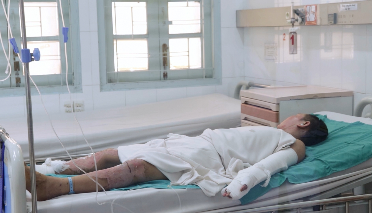 Một trẻ bị phỏng do tai nạn pháo nổ phải điều trị dài ngày (Ảnh BVCC)