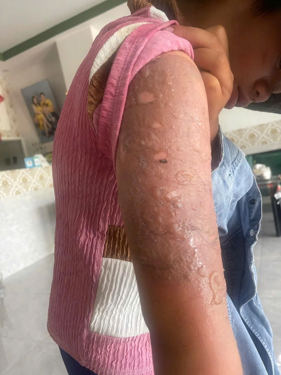 Cánh tay của bé P.D.G.H (12 tuổi) bị tạt nước sôi