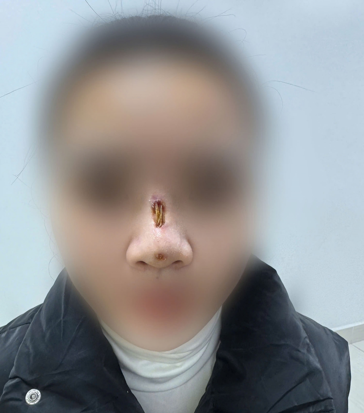 Cô gái trẻ bị thủng mũi sau căng chỉ nâng mũi 3 tháng tại cơ sở thẩm mỹ không rõ nguồn gốc